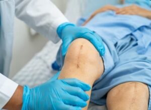 Best Knee Replacement Surgeon in Sector 56, Gurugram