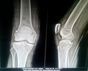 Best Hip Replacement Specilaist in Gurugram