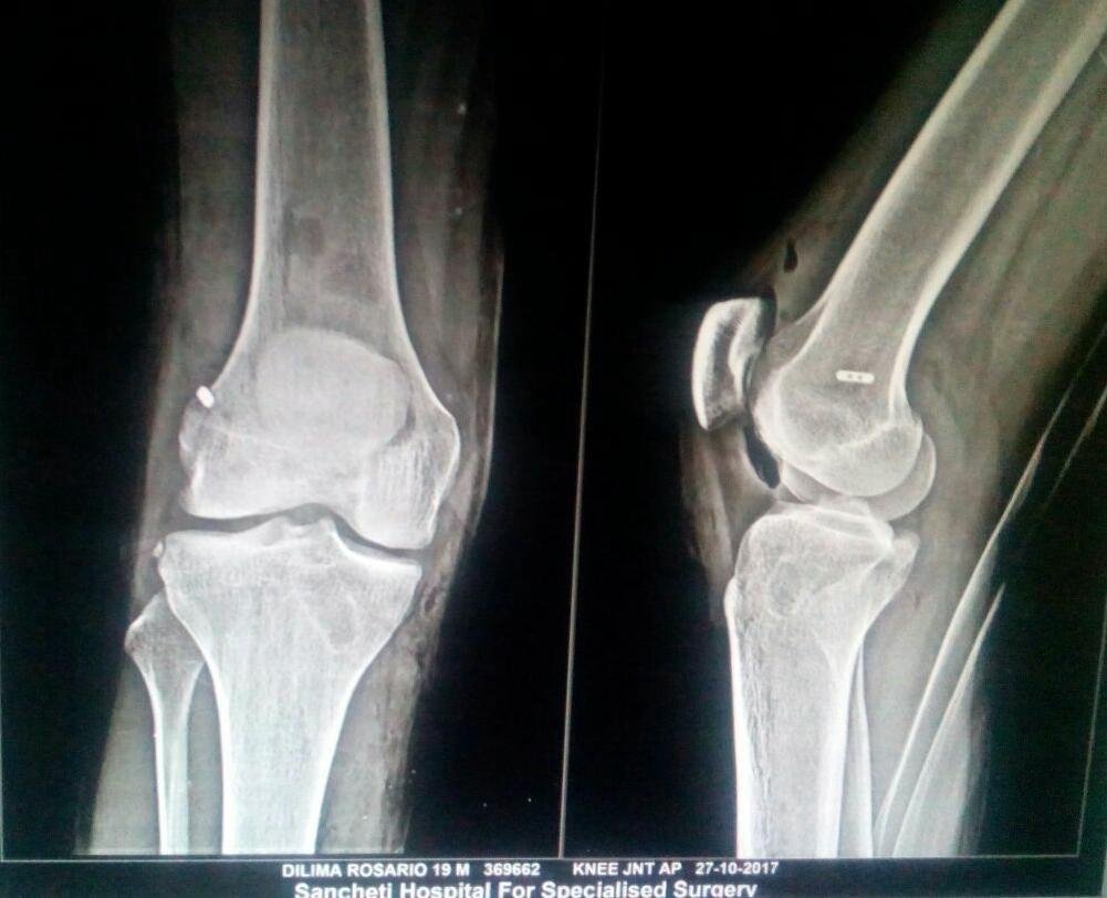 Best Hip Replacement Specilaist in Gurugram