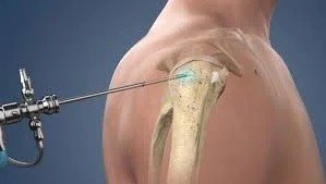 Shoulder Arthroscopy Treatment in Gurugram