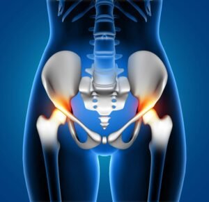 Hip Replacement Surgery in Sector 56 Gurugram