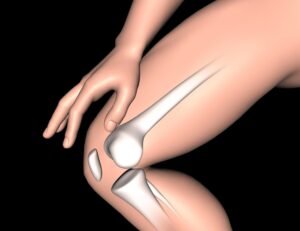 Knee Replacement Surgery in Gurugram