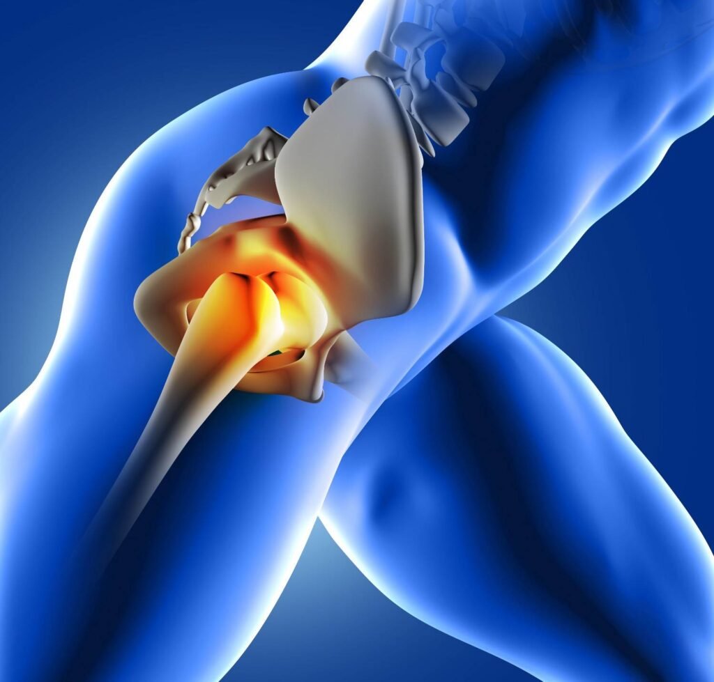 Hip Replacement Surgery in Gurugram