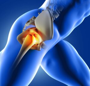Hip Replacement Surgery in Gurugram